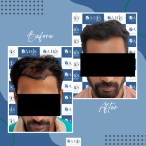 Hair Transplant Clinic in Channapatna