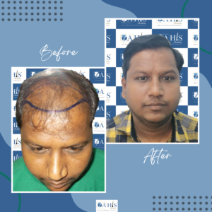 Hair Transplant Clinic in Tumkur