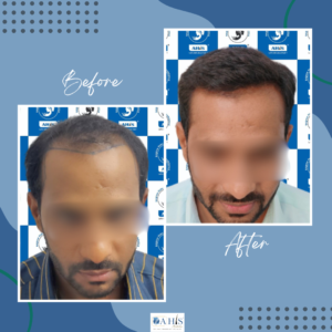Top Hair Transplant Clinic in Coorg