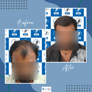 AHIS hair transplant patient result showing front hairline
