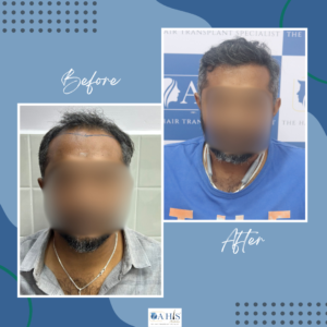 AHIS hair transplant patient result showing top coverage