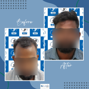 AHIS hair transplant patient result showing side profile