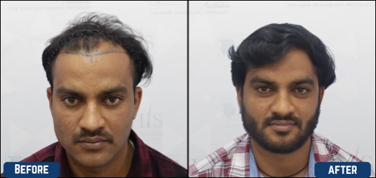 best hair loss treatment in bangalore