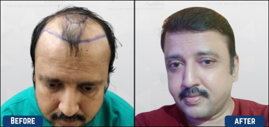 best hair transplant clinic mysore