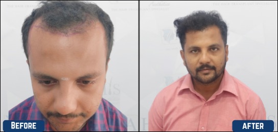 Best Hair growth clinic in India