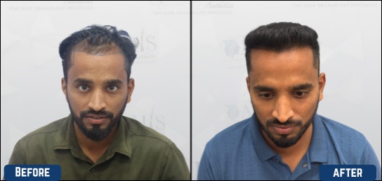 best hair transplant clinic in bangalore