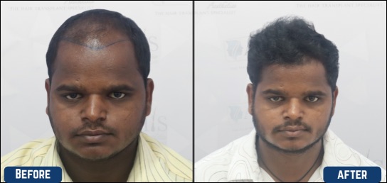 Best Hair clinic in mysore