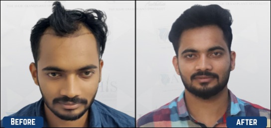 Best Hair clinic in India