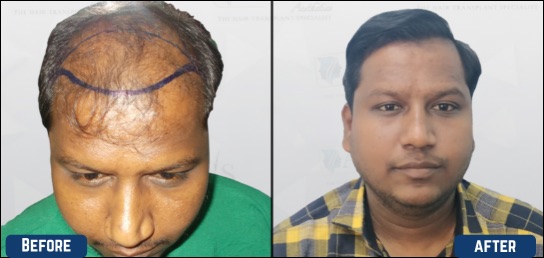 Hair Transpalnt treatment in karnataka