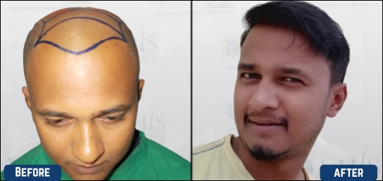 Best Hair clinic in India