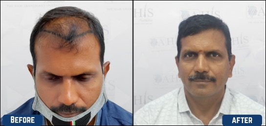 Hair restoration in karnataka