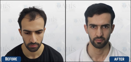 Best Hair clinic in coorg