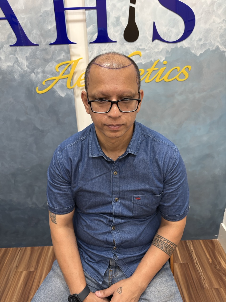 Before hair transplant showing hair loss from front to crown
