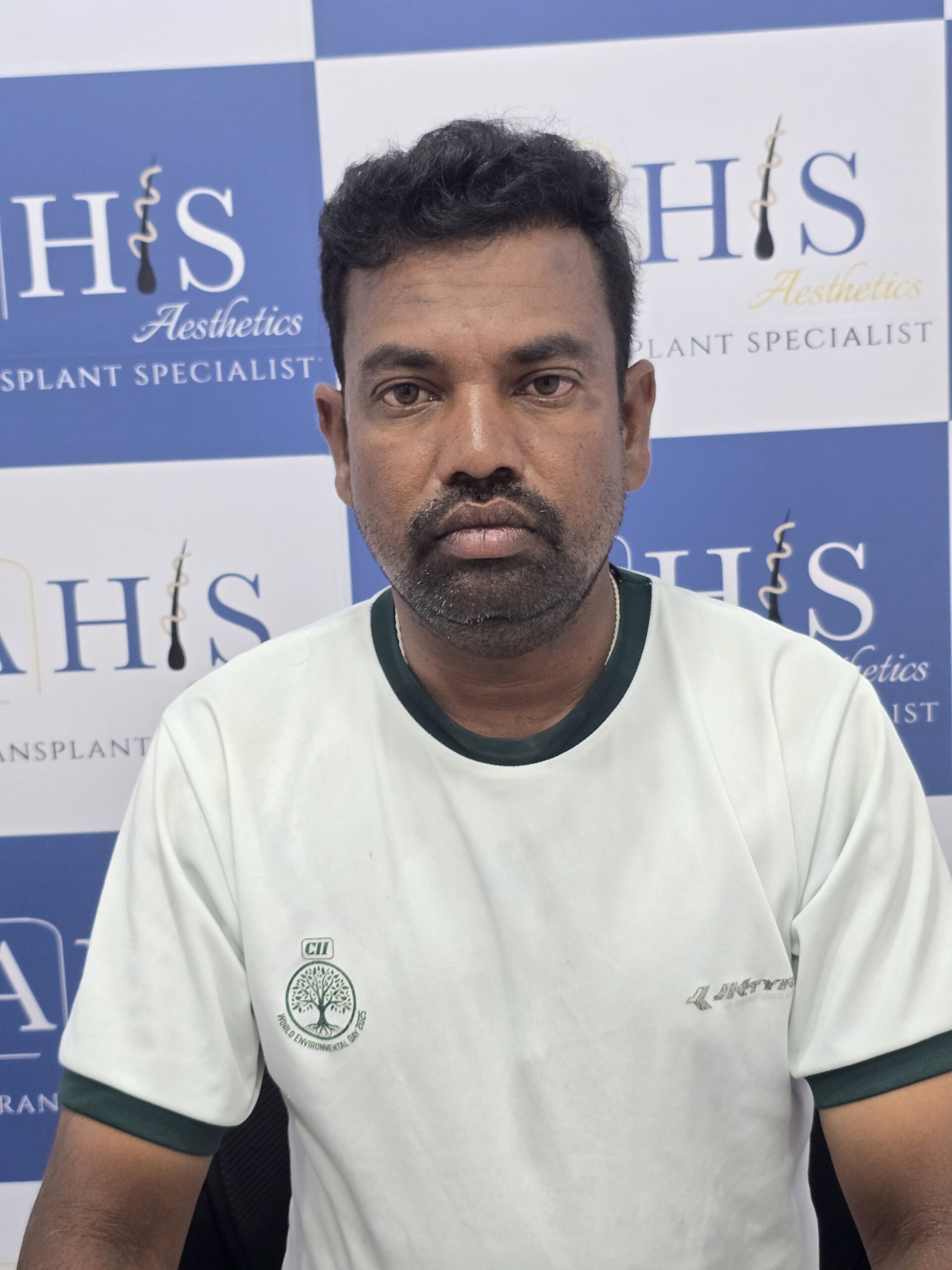 Hair transplant result after nine months