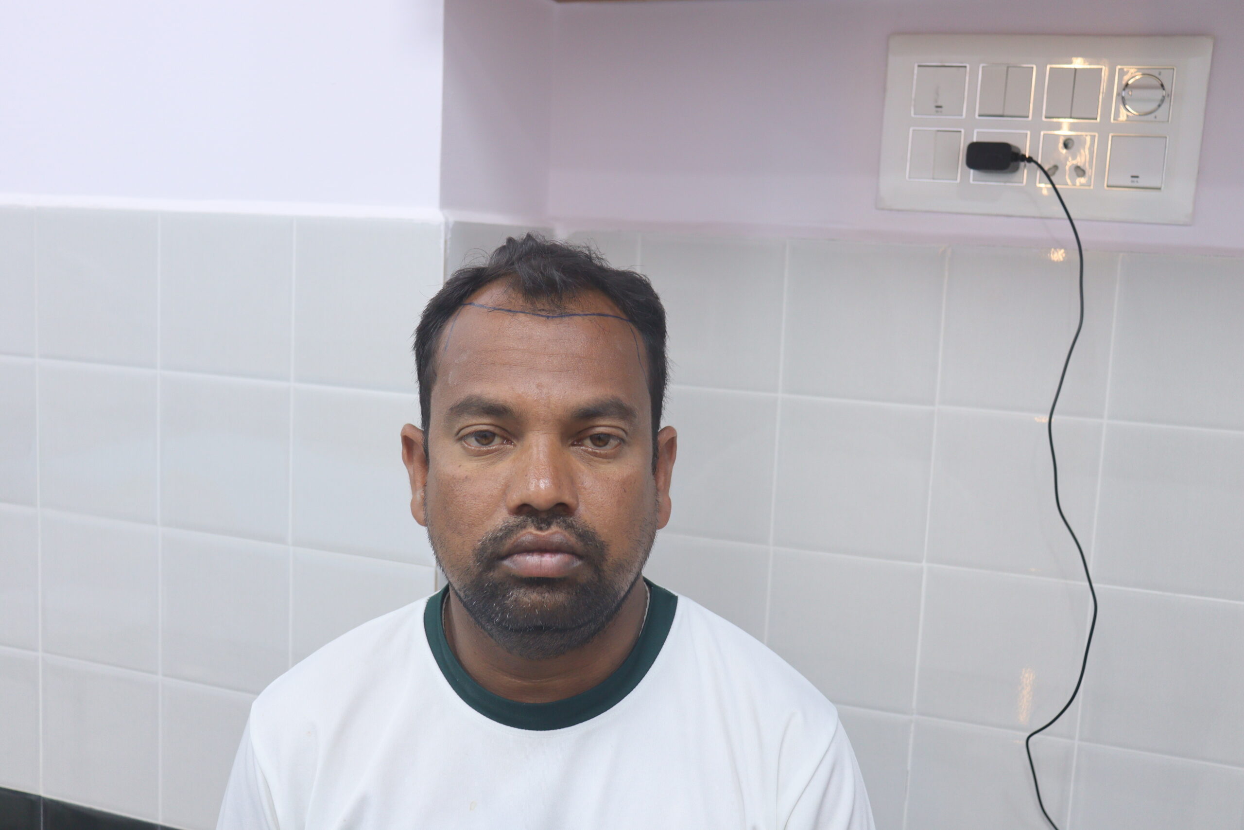 Before hair transplant showing hairline and mid scalp hair loss