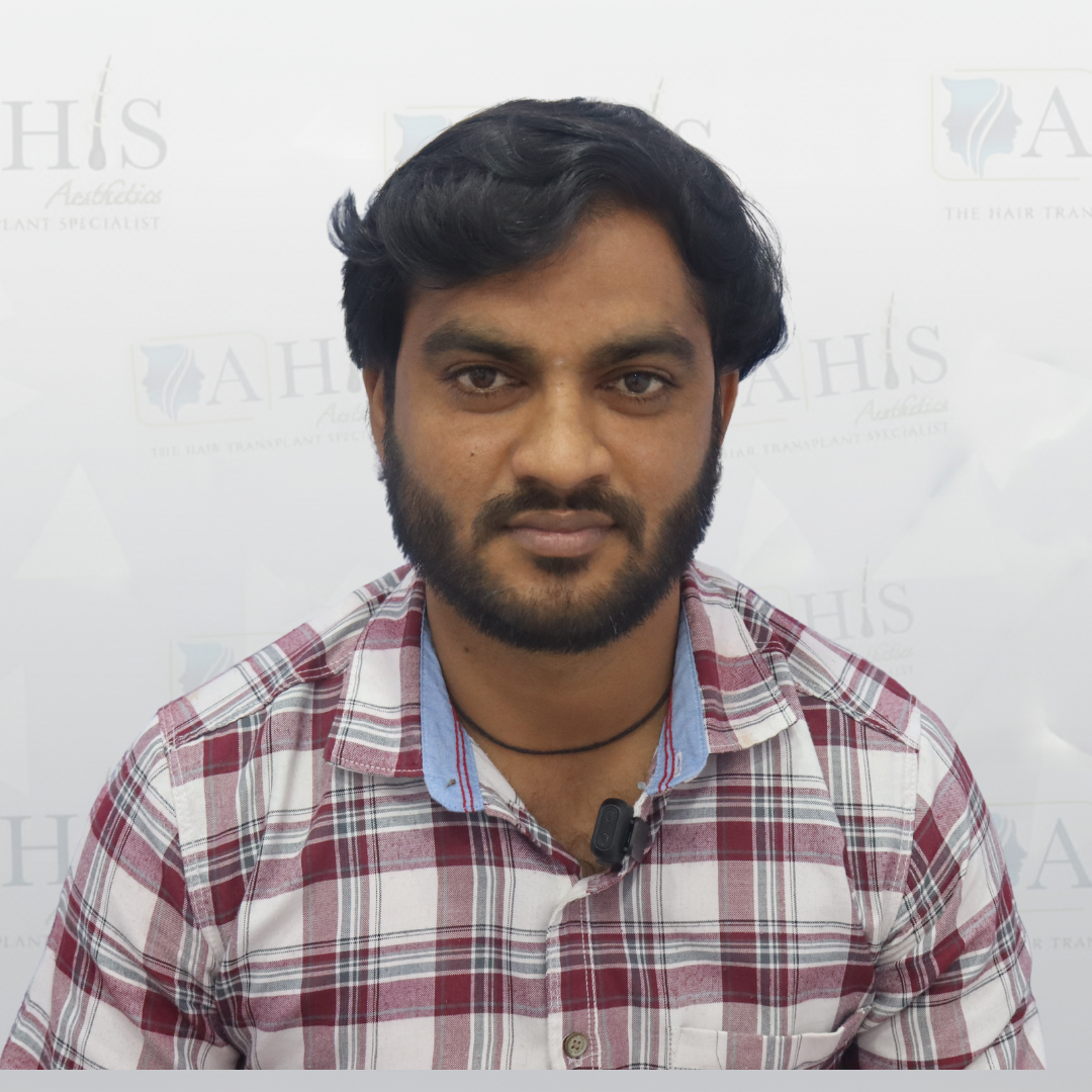 Hair transplant result after eight months