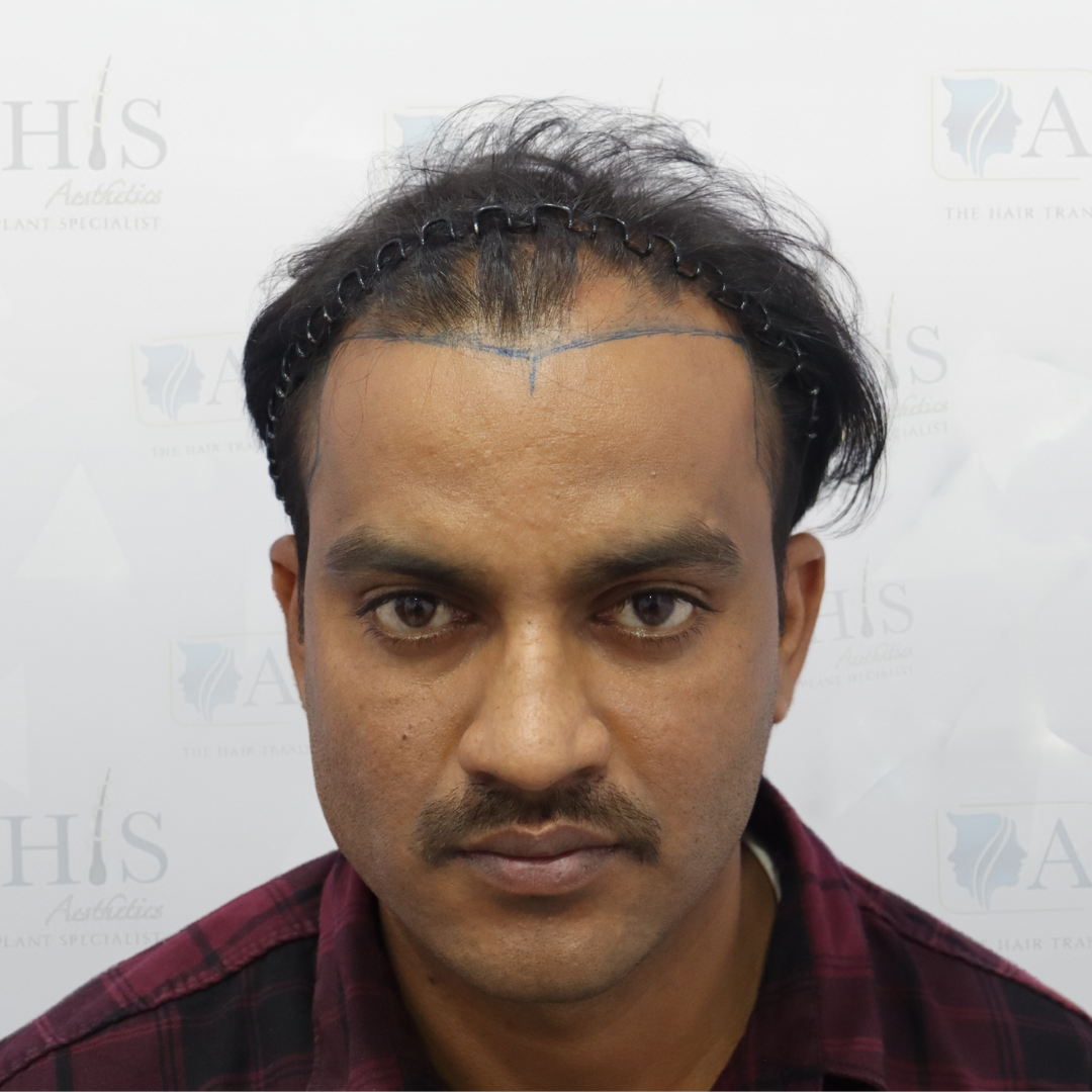 Before hair transplant showing hairline and mid scalp hair loss