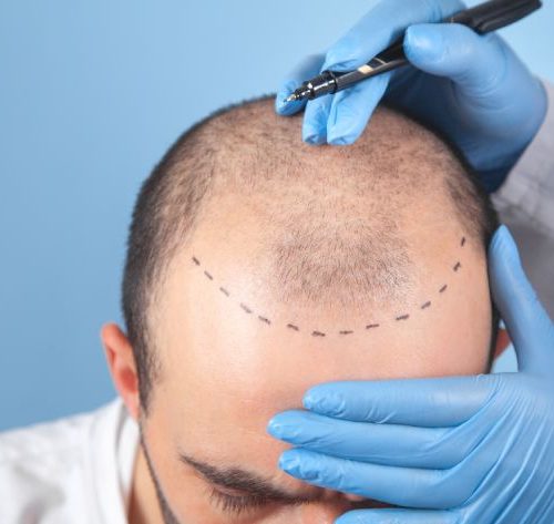 AHIS Aesthetics - Best Hair Transplant treatment clinic in Bangalore