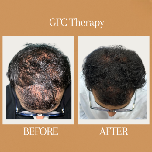 AHIS Aesthetics - Best GFC Treatment clinic in Bangalore